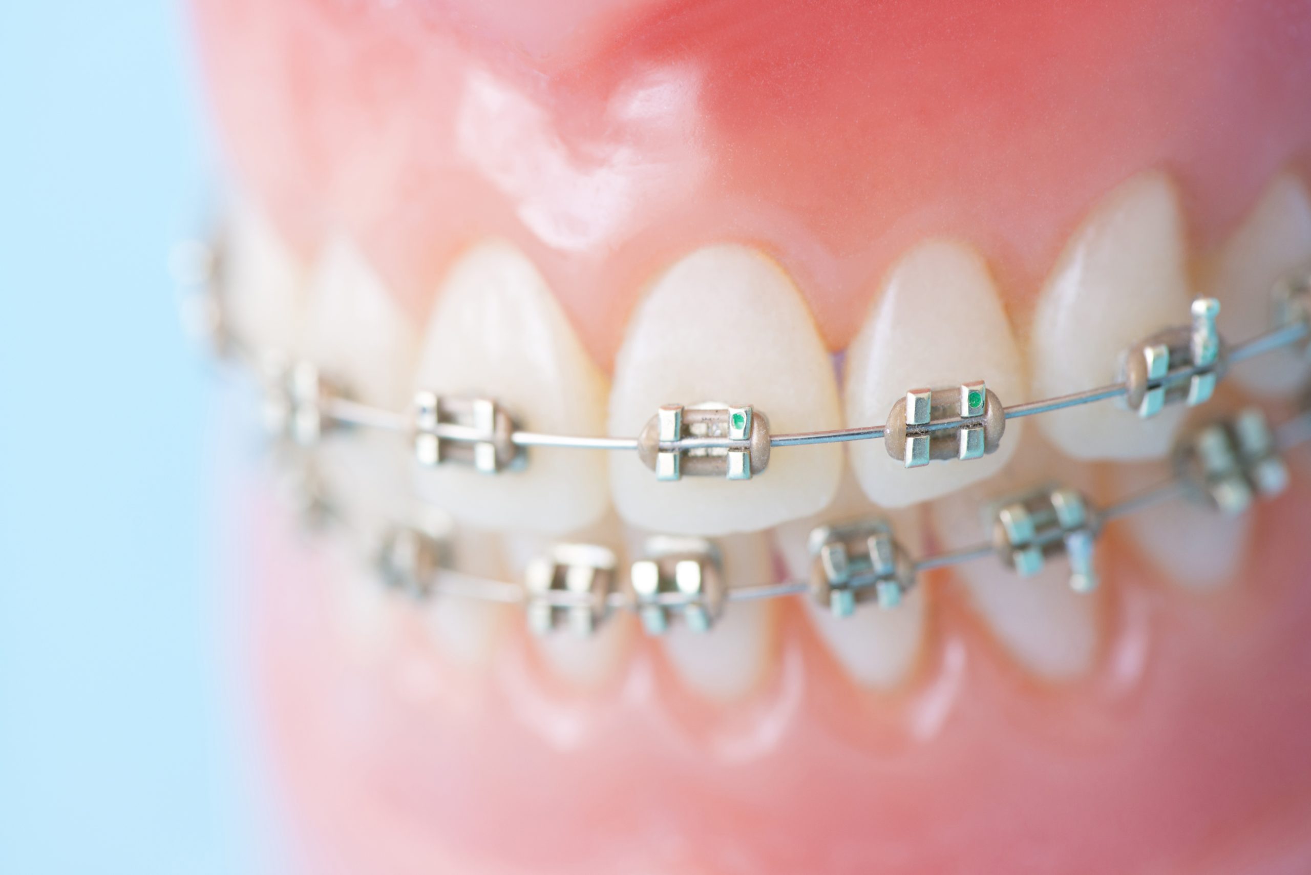 表側矯正（ワイヤー矯正）