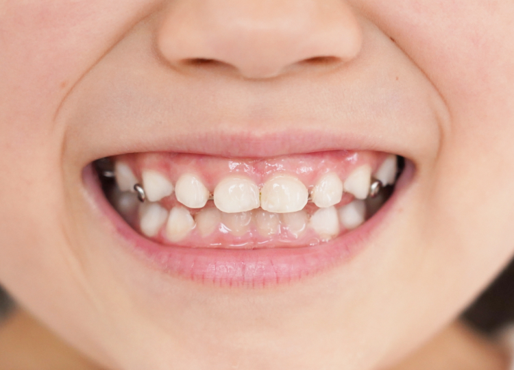 お子さまの歯並び治療